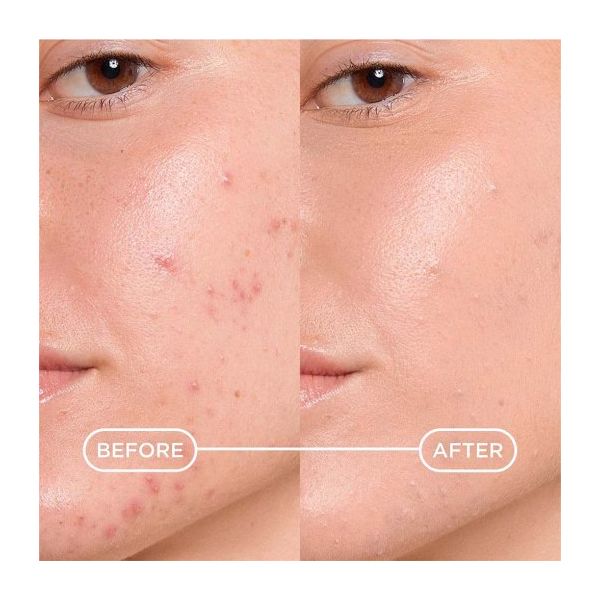 Bioderma Sebium Kerato+ Cover Κρέμα-Τζελ με Χρώμα κατά των Ατελειών για δέρμα με Τάση Ακμής 30 ml